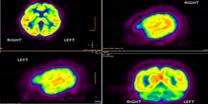 PET (positron emission tomography) scan of the brain These are computer generated images called PET (positron emission tomography) of the brain. It consists of injecting a radioactive analogue of glucose, FDG (fluorodeoxyglucose) into the bloodstream; the three-dimensional images of tracer concentration within the brain are then constructed by computer computer analysis. The more metabolically active areas will retain more FDG, and consequently retain more radioation (orange color). It is an important tool for detecting malignant tumors such as metastasis mainly in other parts of the body. In the brain, it also has been used to detect areas of the brain that generate seizures, they are less metabolically active.